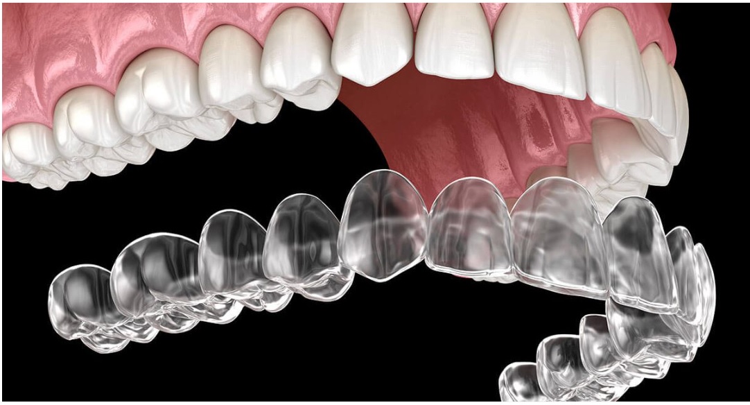 Clear Aligners